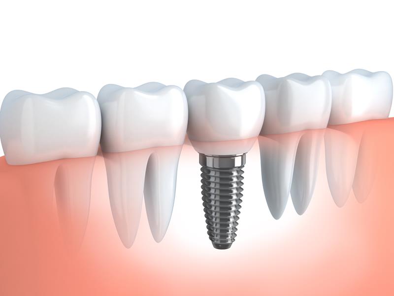 Dental Implants  Bellingham, WA