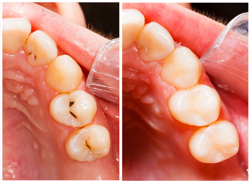 Fillings Bellingham, WA