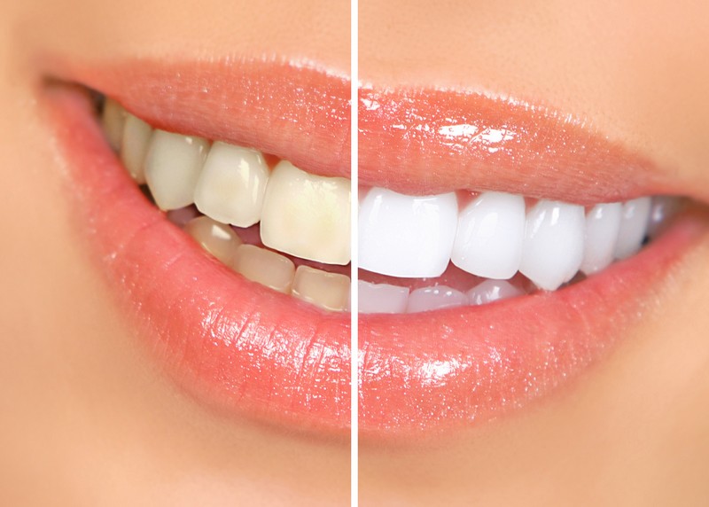 Teeth Whitening Bellingham, WA