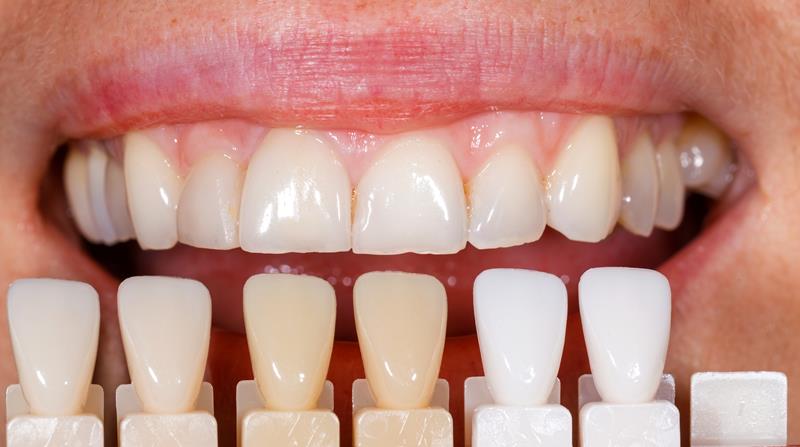 Veneers  Bellingham, WA